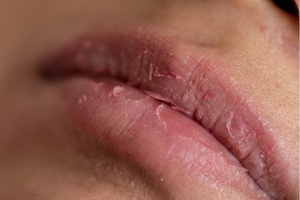 Bad Lip Eczema CLose Up - Beat Eczema  Skin Problems Now:  