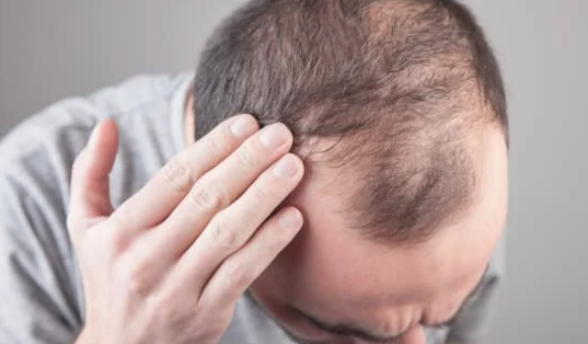 View of Male Hair Loss