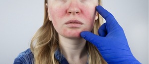Girl's Face being examined to beat eczema skin problems now