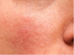 closeup of eczema on cheek of girl