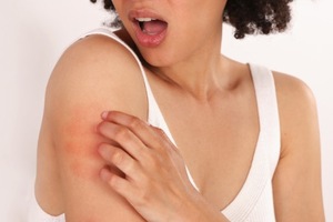 Girl with eczema on shoulder