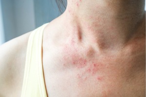 Example of Eczema