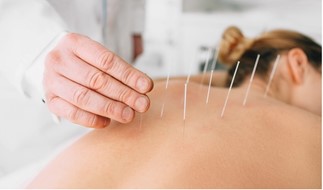 Acupuncture being applied -