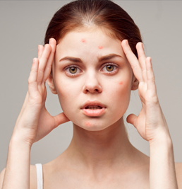 Girl with Acne, worrying about getting rid of pimples